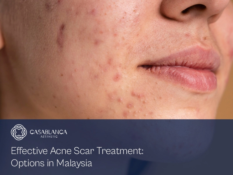 acne-scar-treatment