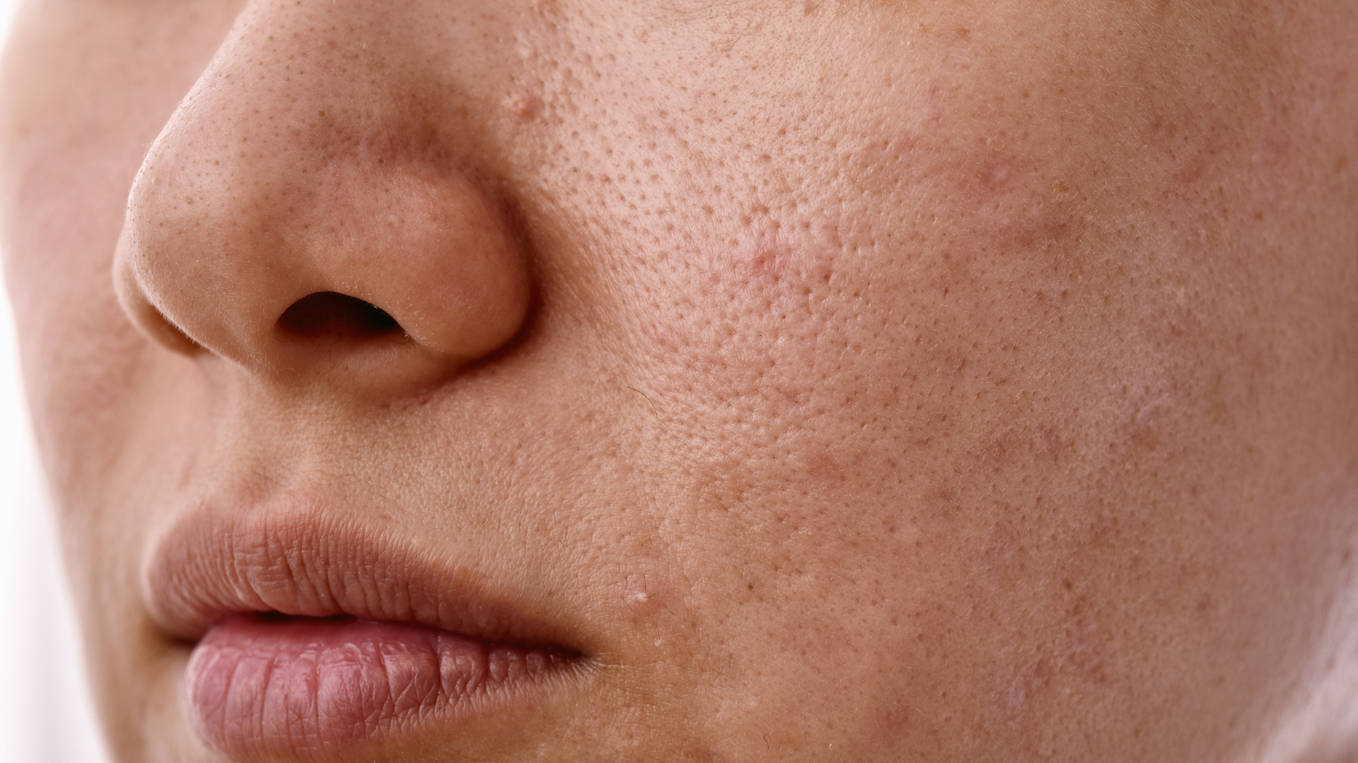 Uneven skin tone