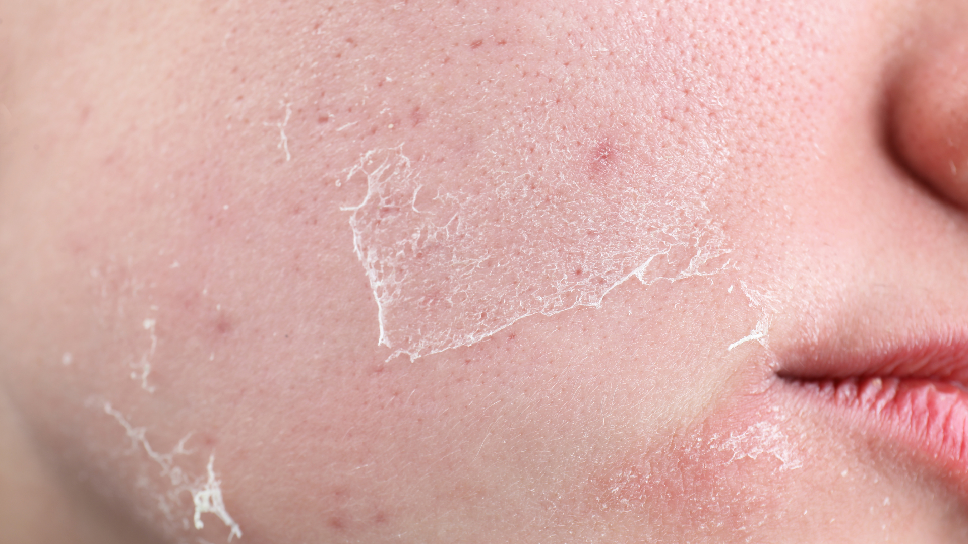 Dehydrated skin