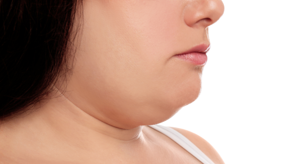 Double chin