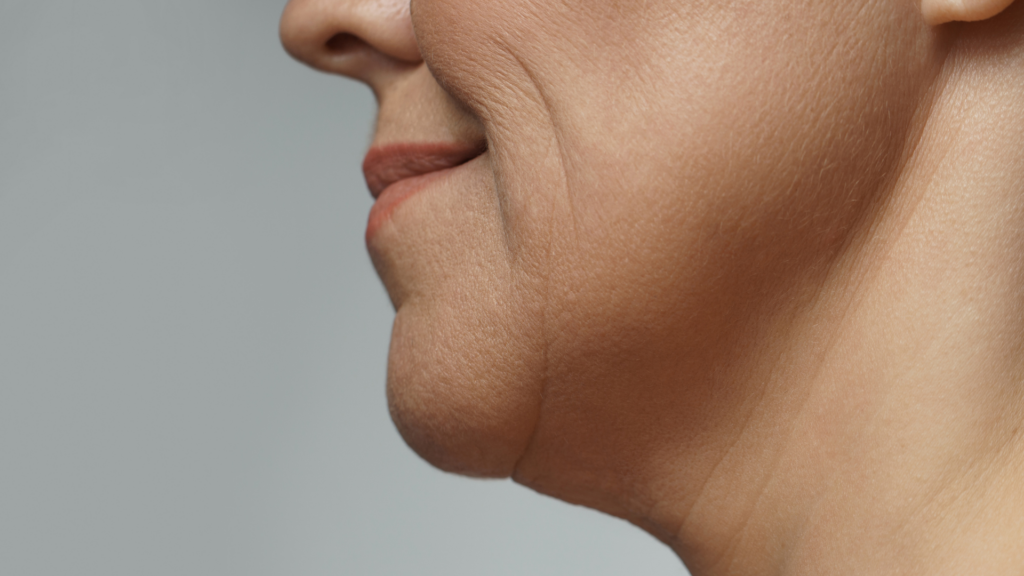 Jawline loss of definition
