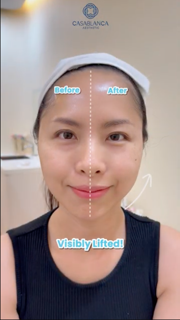 before and after hifu lifting