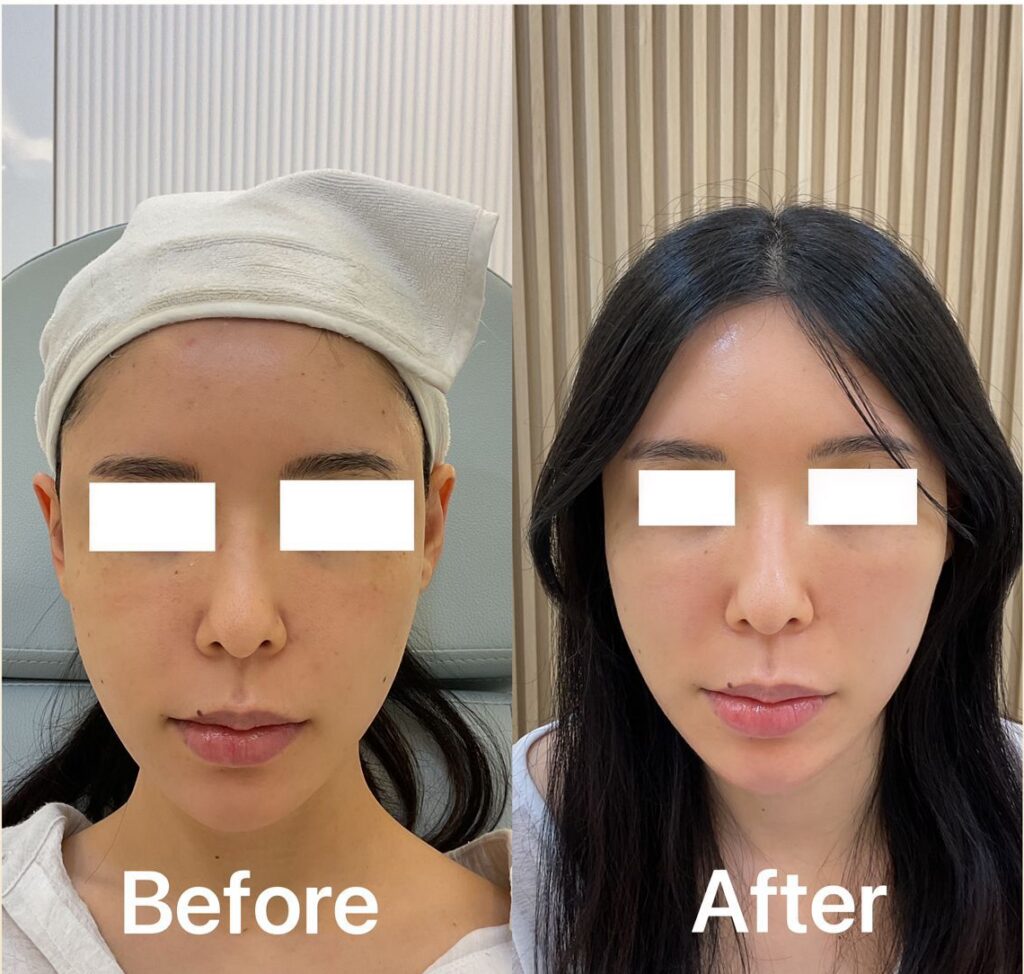 before and after prp skin treatment - chinese