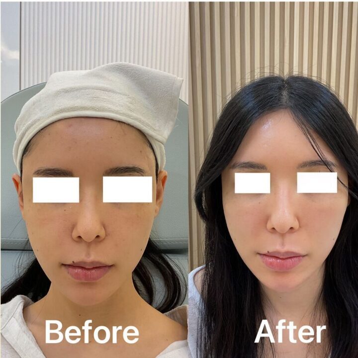 Before and after PRP skin treatment result