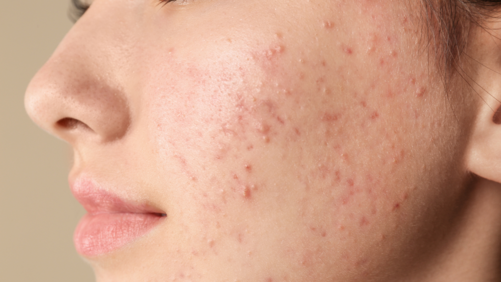 acne scar