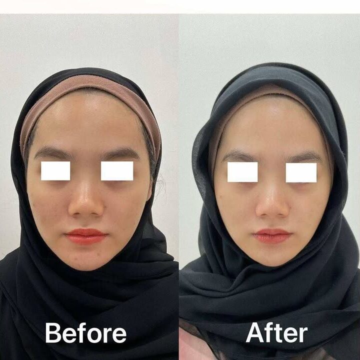before and after prp skin treatment - malay