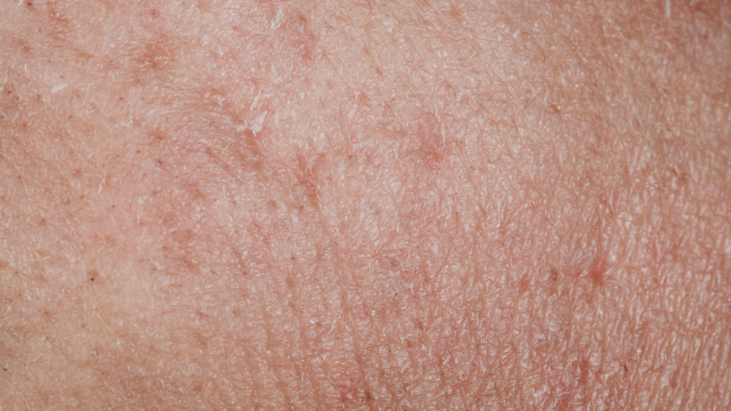 rough skin texture