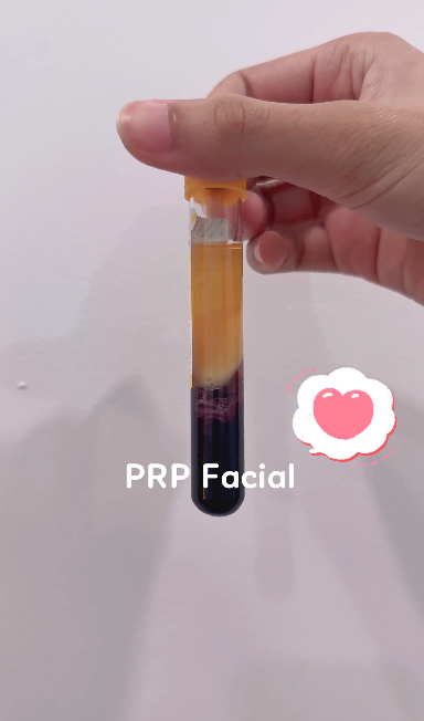 PRP blood draw process at Casablanca Aesthetic