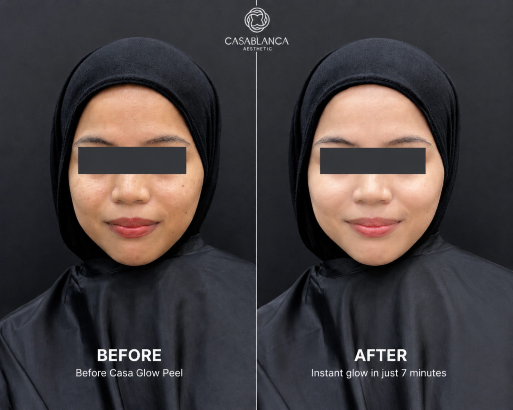 before and after glow peel facial