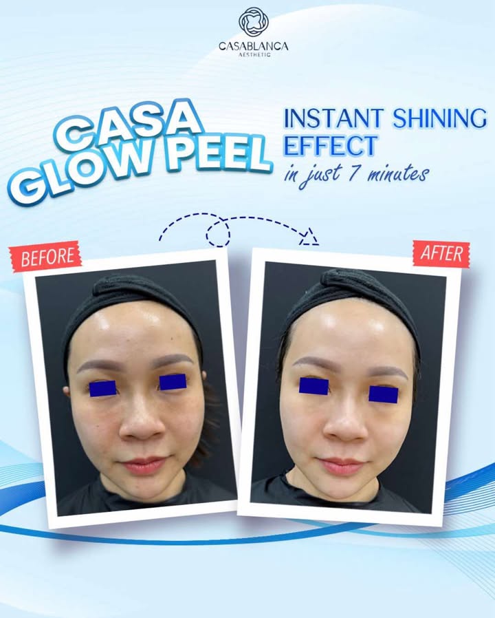 Glow Peel Facial before and after skin texture result at Casablanca Aesthetic KL